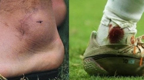 El tobillo de Maradona a la izquierda en Italia 90. Al lado, el de Messi ante Colombia.