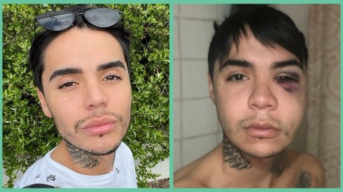El antes y del después de la bichectomía de Leo Méndez Jr.
