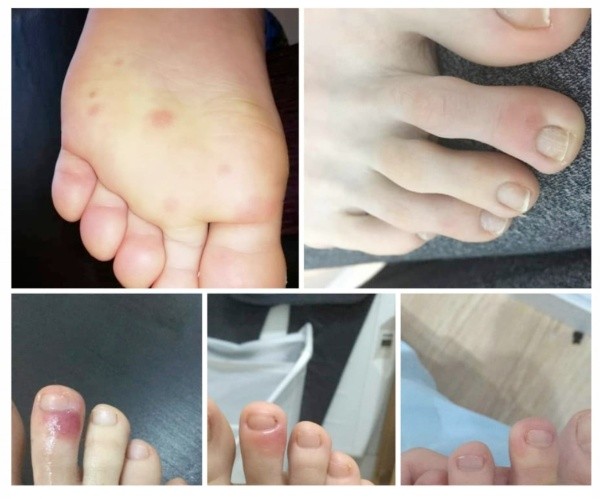 Las manchas son similares a las de la varicela.