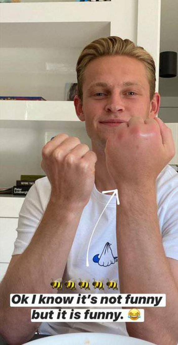 De Jong y su mano hinchada.