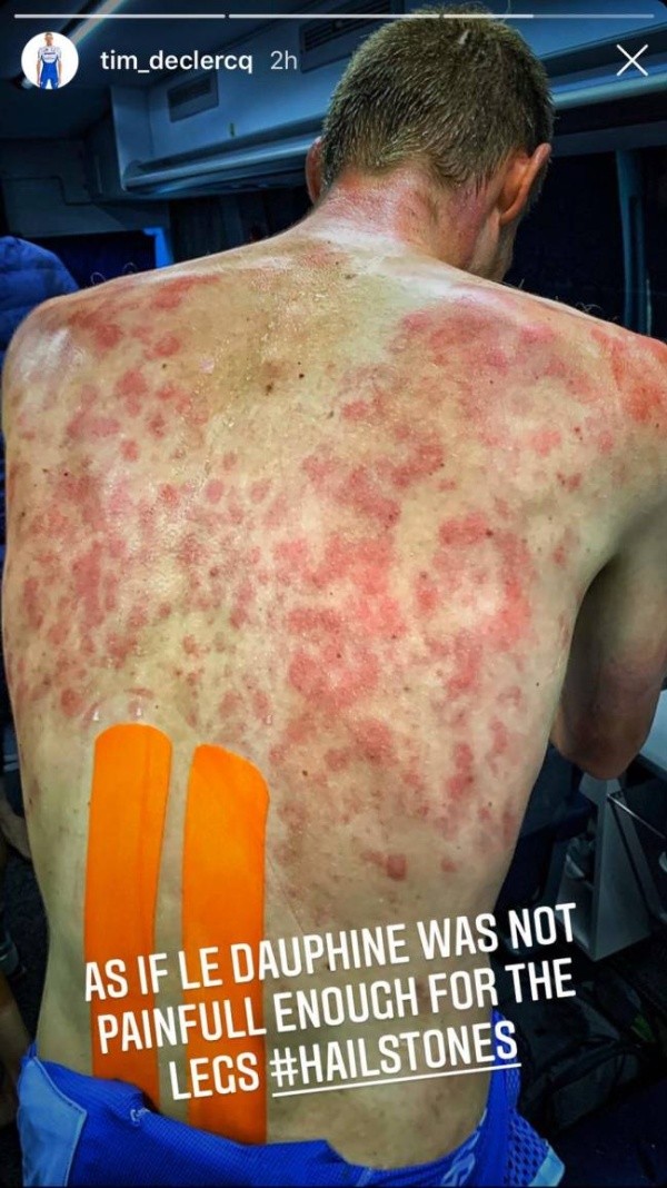 Así quedó la espalda de los ciclistas tras la lluvia de granizos.