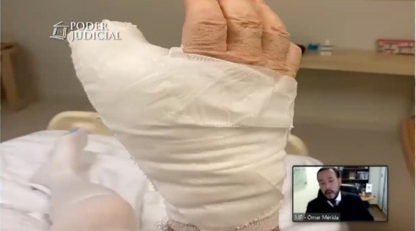 La mano derecha de Calderón sufrió cortes importantes de tendones.