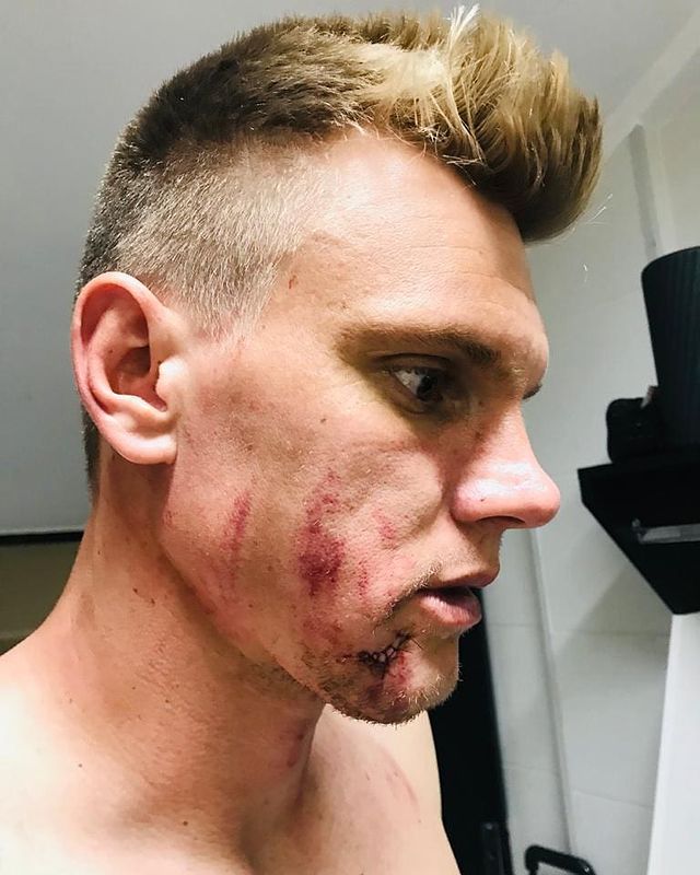 Así quedó el rostro de Fiedrich tras el planchazo.