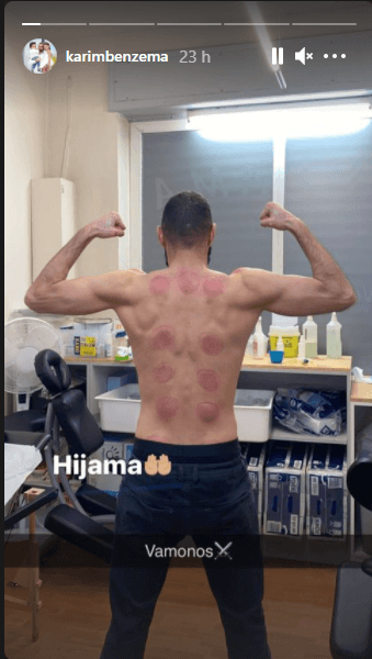 El resultado del tratamiento de Karim Benzema