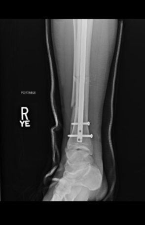 Weidman terminó con un fierro y tres tornillos. Foto: Twitter