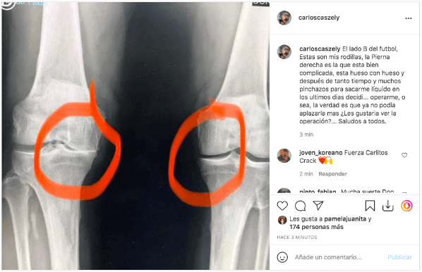 La radiografía que compartió Carlos Caszely, mostrando su rodilla pulverizada.