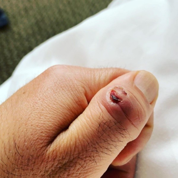 La publicación de Álvaro López tras compartir el estado de su dedo, tras el corte que sufrió en el primer episodio de Masterchef Celebrity.(2)