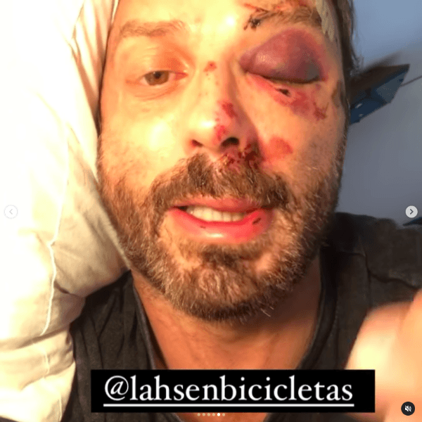 Las heridas de Javier Fernández tras el accidente en bicicleta.