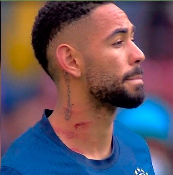 Así le quedó el cuello al jugador brasileño