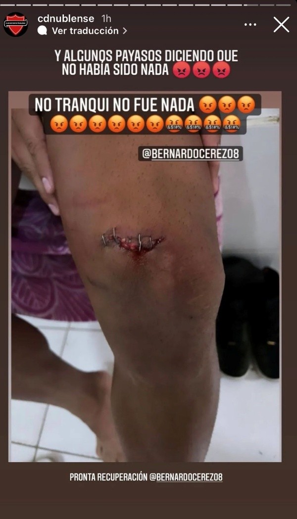 Ñublense mostró cómo quedó la pierna izquierda de Cerezo