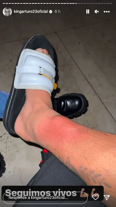 Así le quedó la canilla y el tobillo a Arturo Vidal tras la final de la Copa de Brasil.