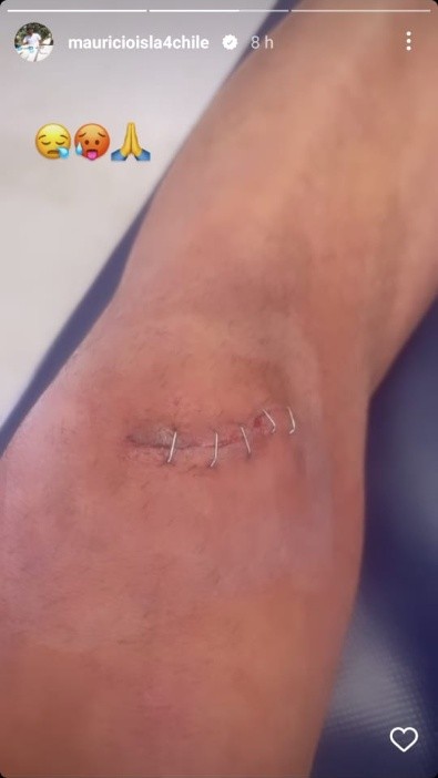 Así lucía la herida de Mauricio Isla este miércoles 2 de noviembre. (Instagram).