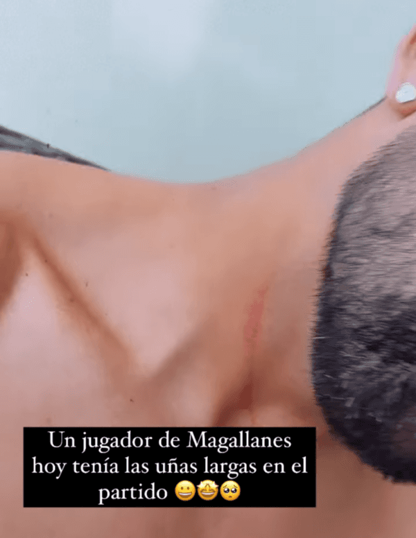 Así quedó el cuello de Mauricio Isla.